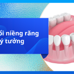Độ tuổi niềng răng lý tưởng