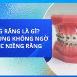 NIỀNG RĂNG LÀ GÌ? 4 TÁC DỤNG KHÔNG NGỜ TỪ VIỆC NIỀNG RĂNG