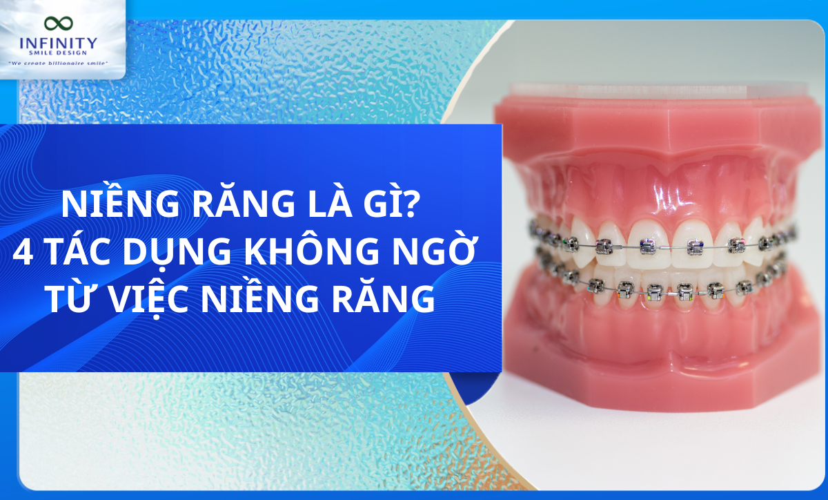 NIỀNG RĂNG LÀ GÌ? 4 TÁC DỤNG KHÔNG NGỜ TỪ VIỆC NIỀNG RĂNG