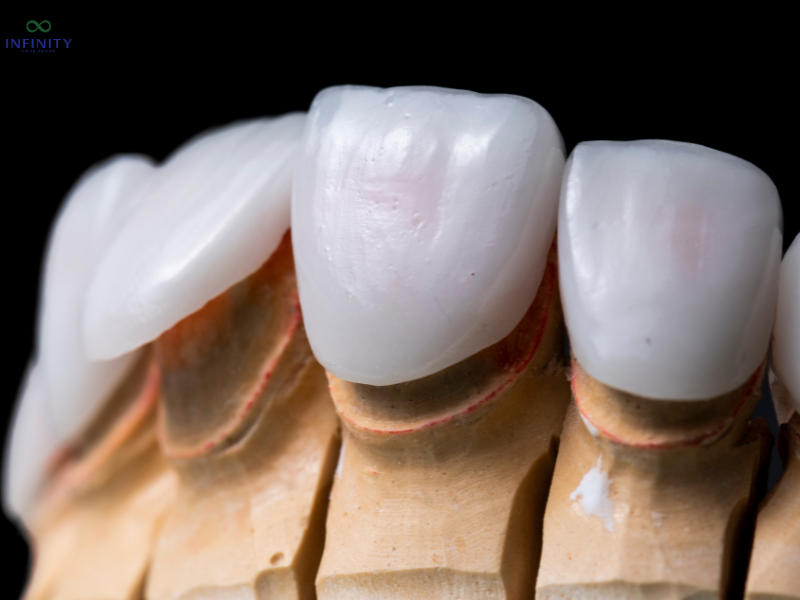 Phục hình răng sứ veneer
