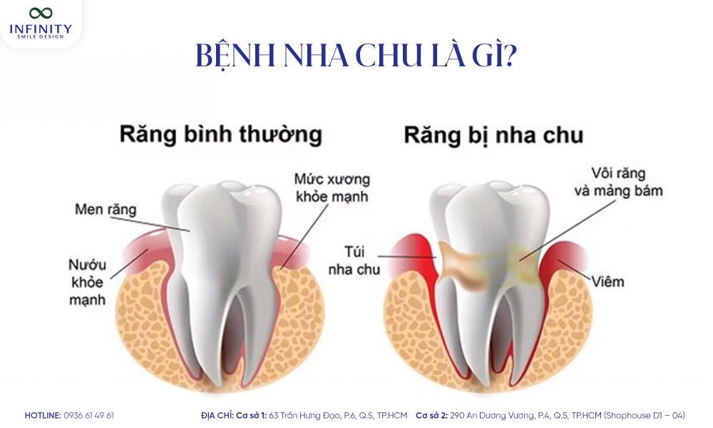 1. Bệnh nha chu là gì