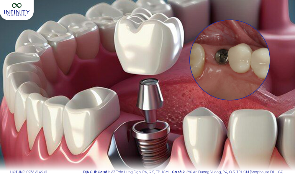 1. implant lẻ là gì 1