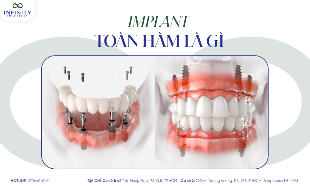 1. implant toàn hàm là gì