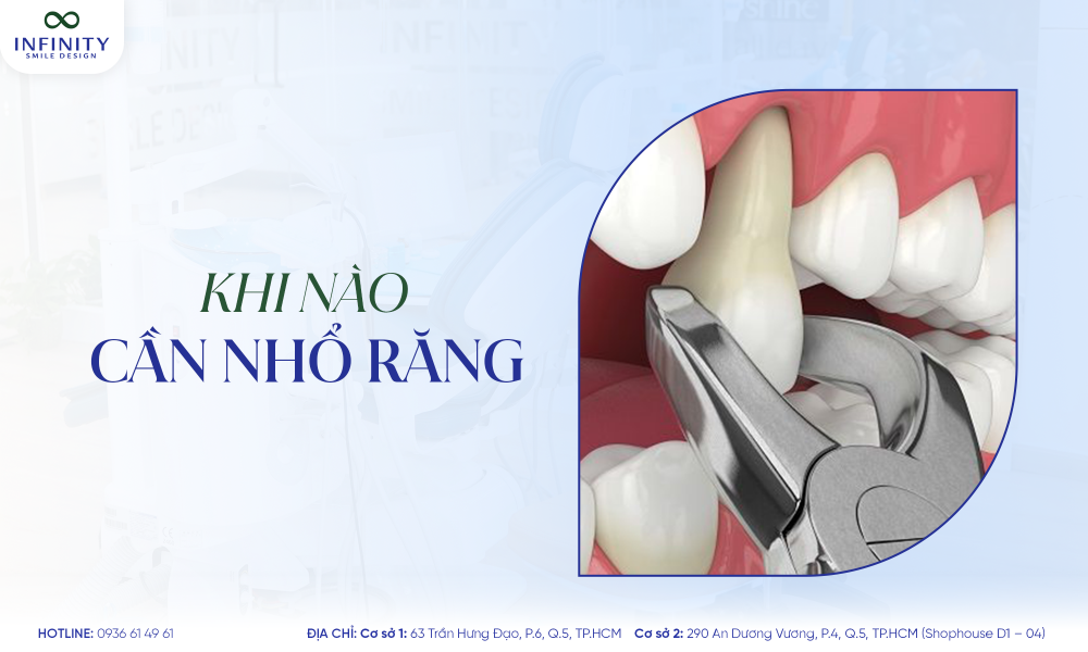 1. khi nào cần nhổ răng