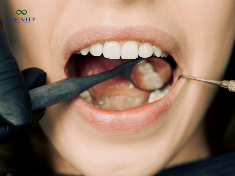 Quy trình thực hiện kéo răng số 7 thay răng số 6