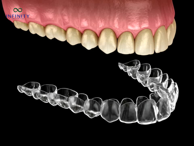 Lưu ý khi lựa chọn niềng răng Invisalign