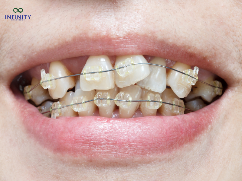 Các phương pháp niềng răng khấp khểnh