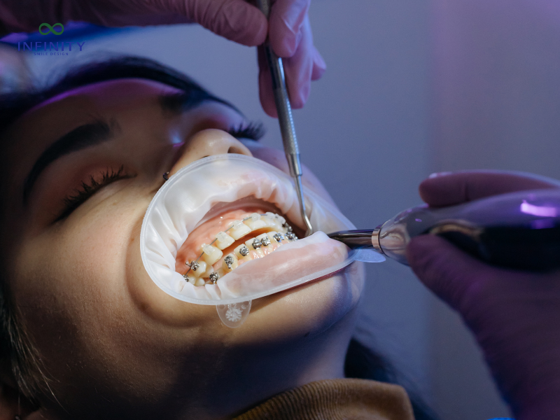 Chi phí niềng răng mắc cài kim loại