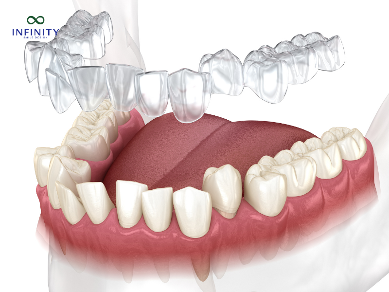 Giới thiệu về niềng răng Invisalign