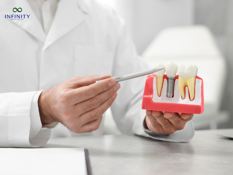 Cấy ghép implant là gì?