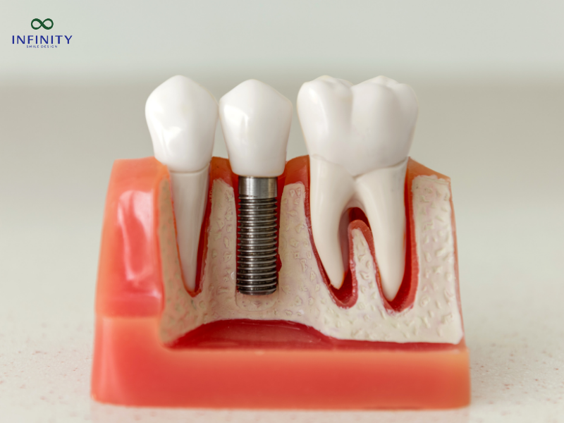 Quy trình cấy ghép implant chi tiết