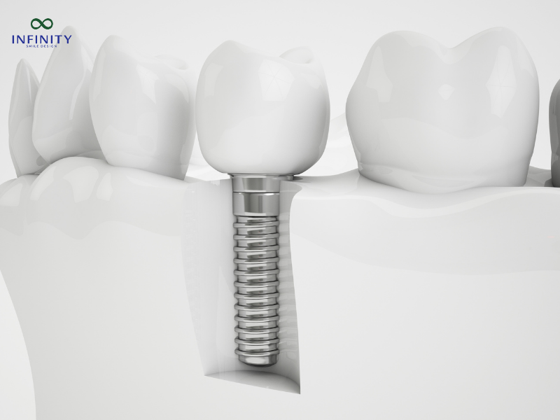 Các trường hợp nào nên thực hiện cấy ghép implant?