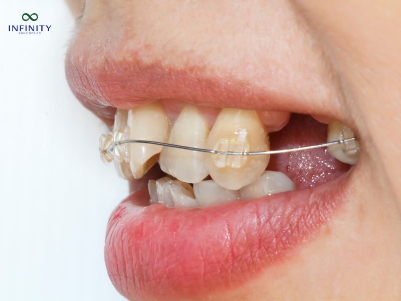 Phương pháp khắc phục răng khểnh 2 bên Phương pháp khắc phục răng khểnh 2 bên