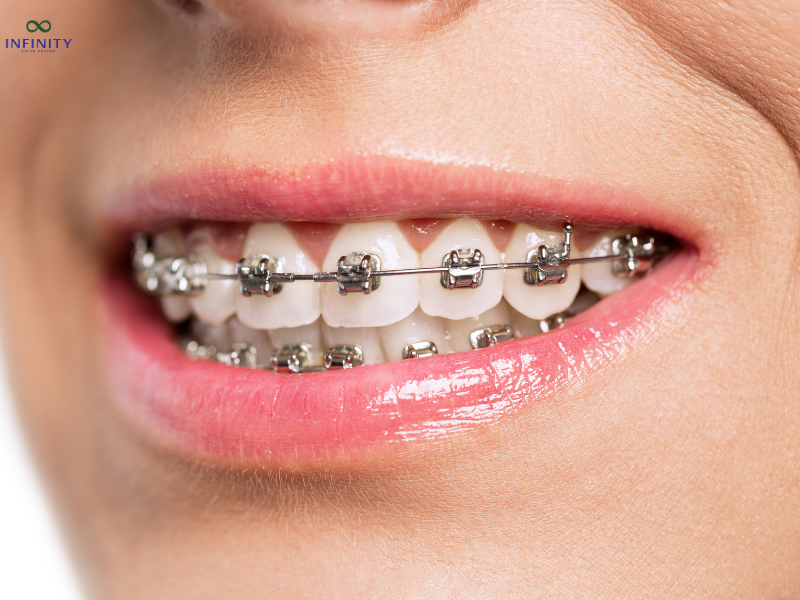 ĐỘ TUỔI NIỀNG RĂNG LÝ TƯỞNG 4 Niềng răng cho thanh thiếu niên (12 - 18 tuổi)