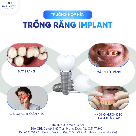 2. nên trồng implant 2