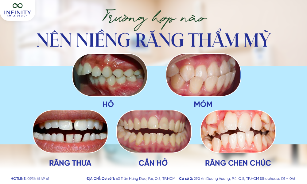 2. trường hợp nào nên niềng răng thẩm mỹ