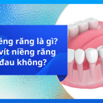 Vít niềng răng là gì? Cắm vít niềng răng có đau không?