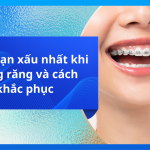 Giai đoạn xấu nhất khi niềng răng và cách khắc phục