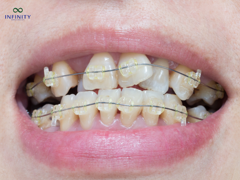 Các phương pháp niềng răng khấp khểnh