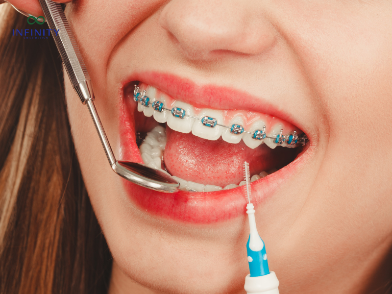 Vai trò của minivis trong chỉnh nha