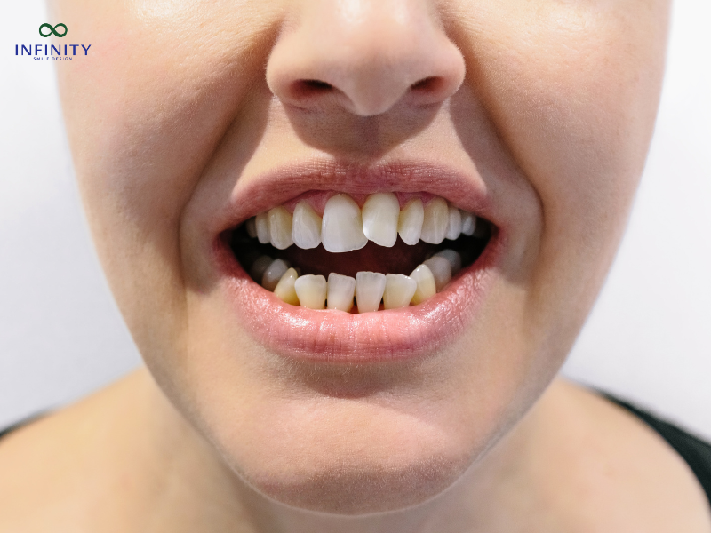 Niềng răng khấp khểnh mất bao lâu? Những yếu tố ảnh hưởng