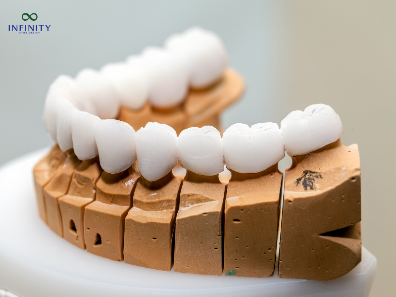 8 kinh nghiệm bọc răng sứ thẩm mỹ an toàn, hiệu quả