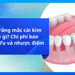 Niềng răng mắc cài kim loại là gì? Chi phí bao nhiêu? Ưu và nhược điểm