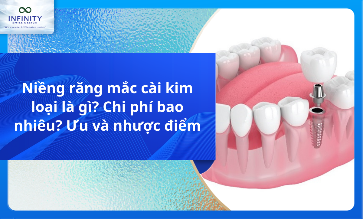 Niềng răng mắc cài kim loại là gì? Chi phí bao nhiêu? Ưu và nhược điểm