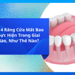 Kéo Cụm 4 Răng Cửa Mất Bao Lâu? Thực Hiện Trong Giai Đoạn Nào, Như Thế Nào?