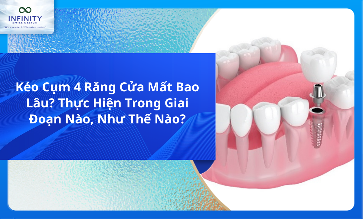 Kéo Cụm 4 Răng Cửa Mất Bao Lâu? Thực Hiện Trong Giai Đoạn Nào, Như Thế Nào?