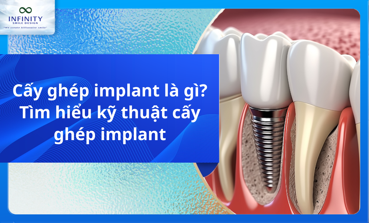 Cấy ghép implant là gì? Tìm hiểu kỹ thuật cấy ghép implant