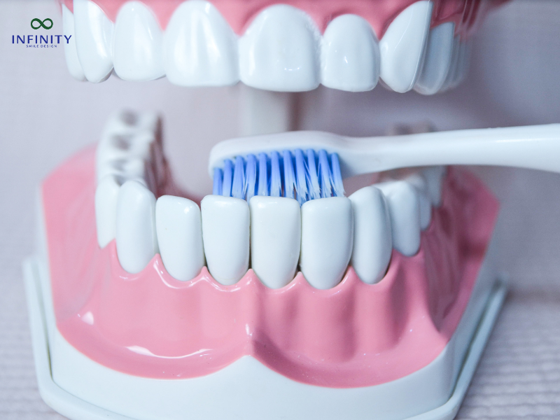 Những điều cần lưu ý khi niềng răng khểnh