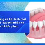 Niềng răng có hết lệch mặt không? Nguyên nhân và cách khắc phục