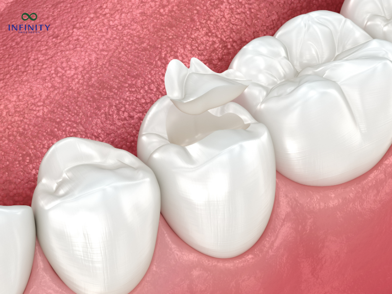 Các yếu tố ảnh hưởng đến chi phí bọc răng sứ