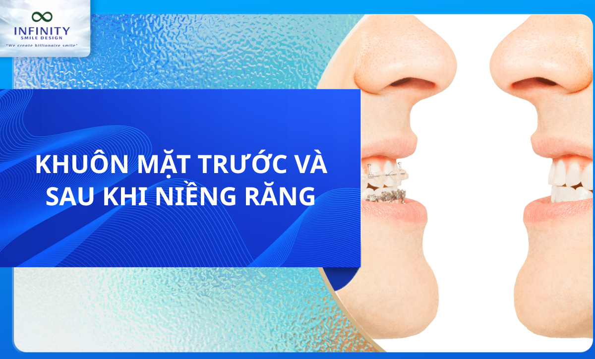 KHUÔN MẶT TRƯỚC VÀ SAU KHI NIỀNG RĂNG