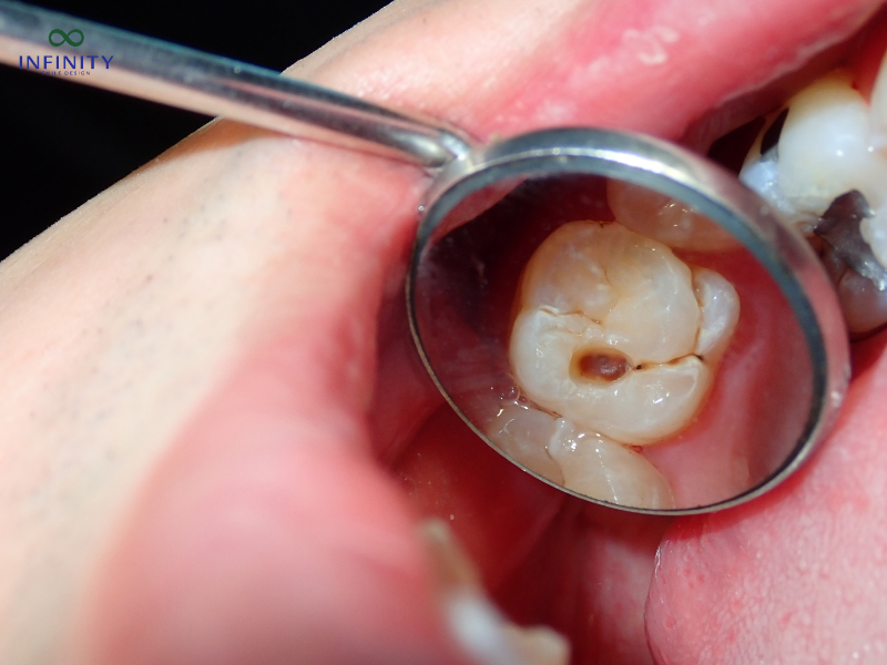 Yếu tố ảnh hưởng đến cảm giác đau khi hàn răng sâu