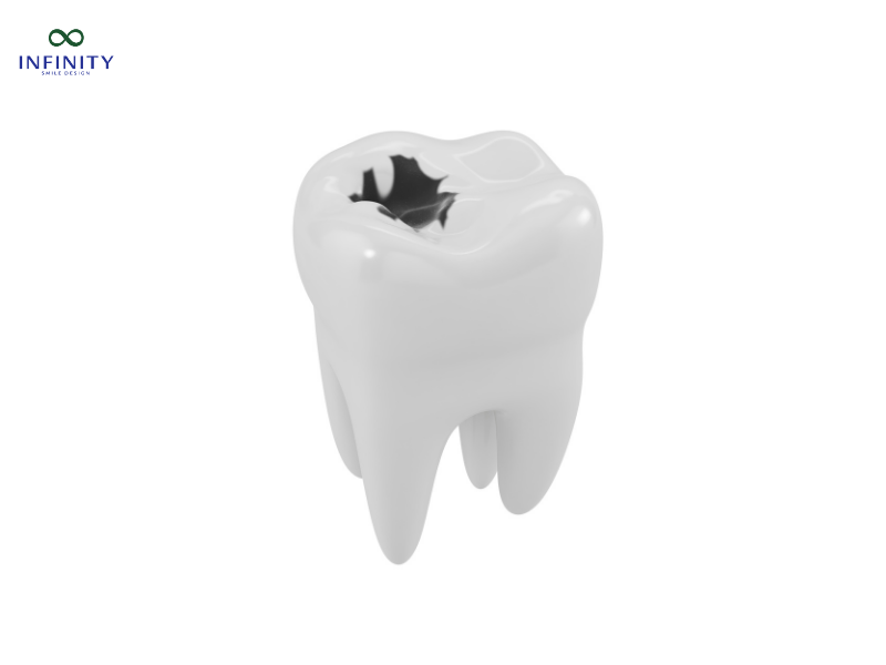 Các loại vật liệu trám răng sâu phổ biến hiện nay