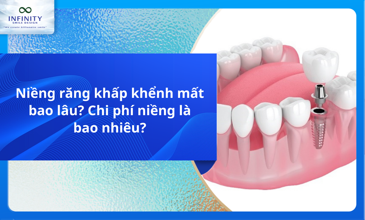 Niềng răng khấp khểnh mất bao lâu? Chi phí niềng là bao nhiêu?