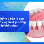 Răng khểnh 2 bên là đẹp hay xấu? Ý nghĩa & phương pháp khắc phục