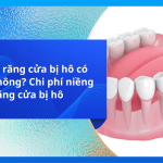 Niềng răng cửa bị hô có được không? Chi phí niềng răng cửa bị hô