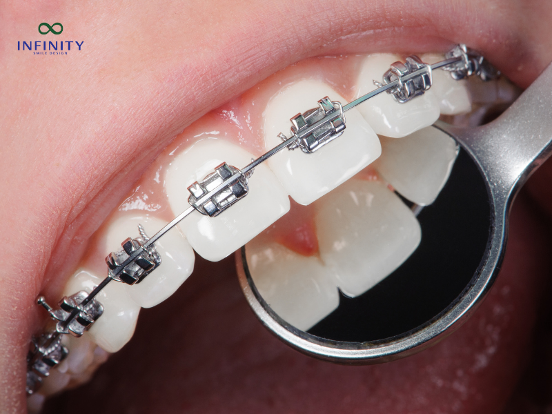 Ưu điểm và nhược điểm của niềng răng mắc cài