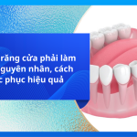 Bị hô 4 răng cửa phải làm sao? Nguyên nhân, cách khắc phục hiệu quả