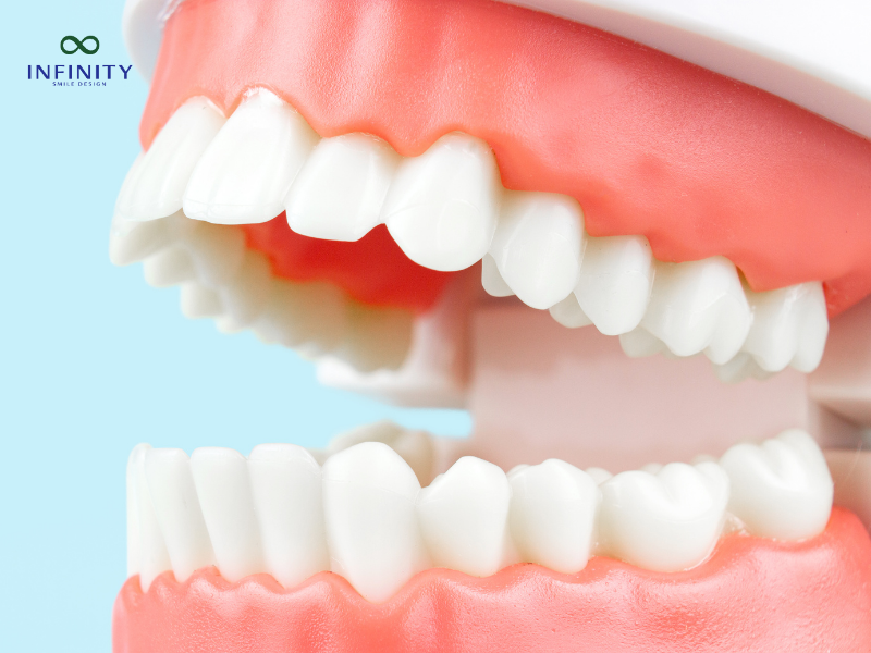 Các phương pháp niềng răng cửa hô hiện nay Các phương pháp niềng răng cửa hô hiện nay