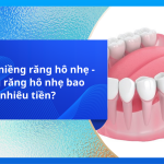 Chi phí niềng răng hô nhẹ - Niềng răng hô nhẹ bao nhiêu tiền?