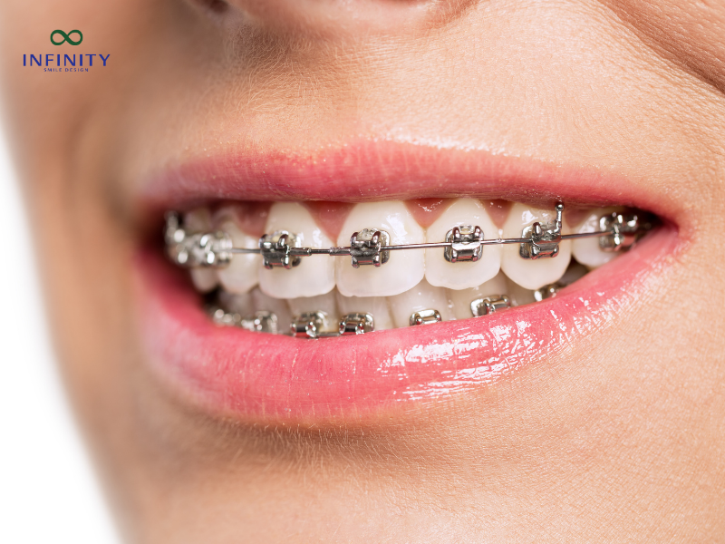 Các loại mắc cài phổ biến hiện nay