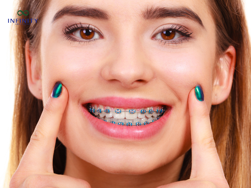 Niềng răng bị lệch mặt là như thế nào? Niềng răng bị lệch mặt là như thế nào?