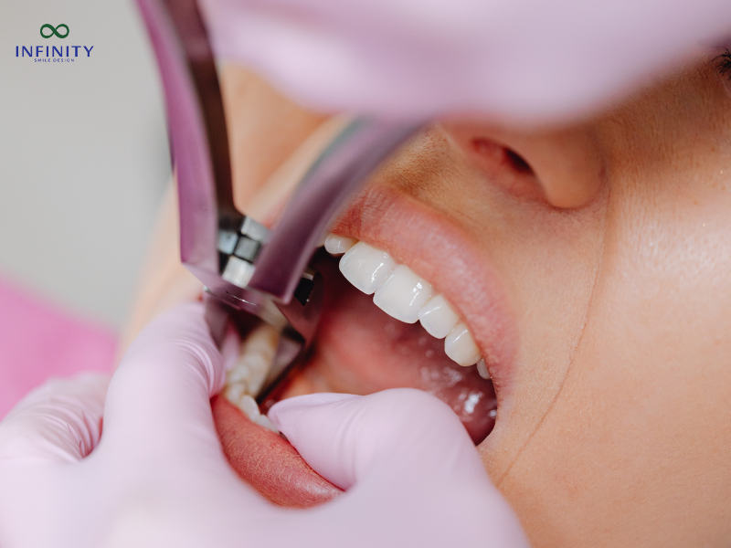 Chi phí cấy ghép implant và các yếu tố liên quan