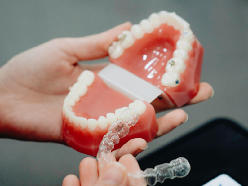 Răng hở khớp cắn là như thế nào? Các dạng hở khớp cắn?