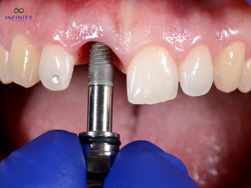 Các loại trụ implant phổ biến hiện nay
