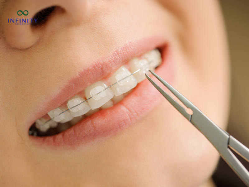 Vai trò của mắc cài trong niềng răng